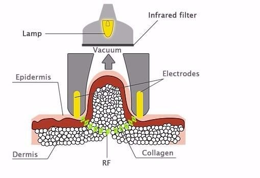 Sincoheren Effective Kuma Shape 3 Beauty Machine RF Infrared Vacuum Body Shaping Contouring Used on Beauty Body SPA