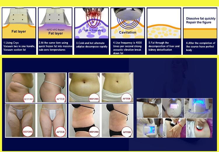 Cryolipolysis 40K Cavitation RF Slimming Beauty Eqyupment for Fat Reduction