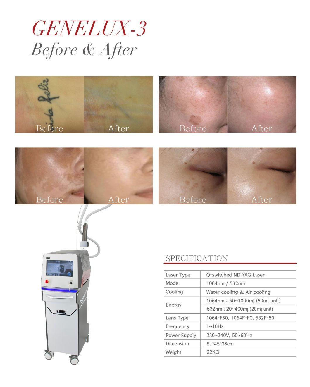 Q Switch ND YAG Laser Permanent Eyebrow Tattoo Removal Device
