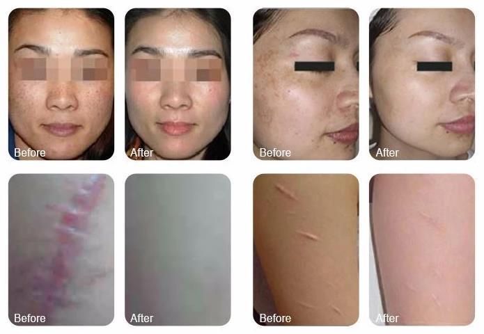 2022 Fotona Fractional CO2 Laser Vaginal Tightening Scar Removal Beauty Salon Equipment