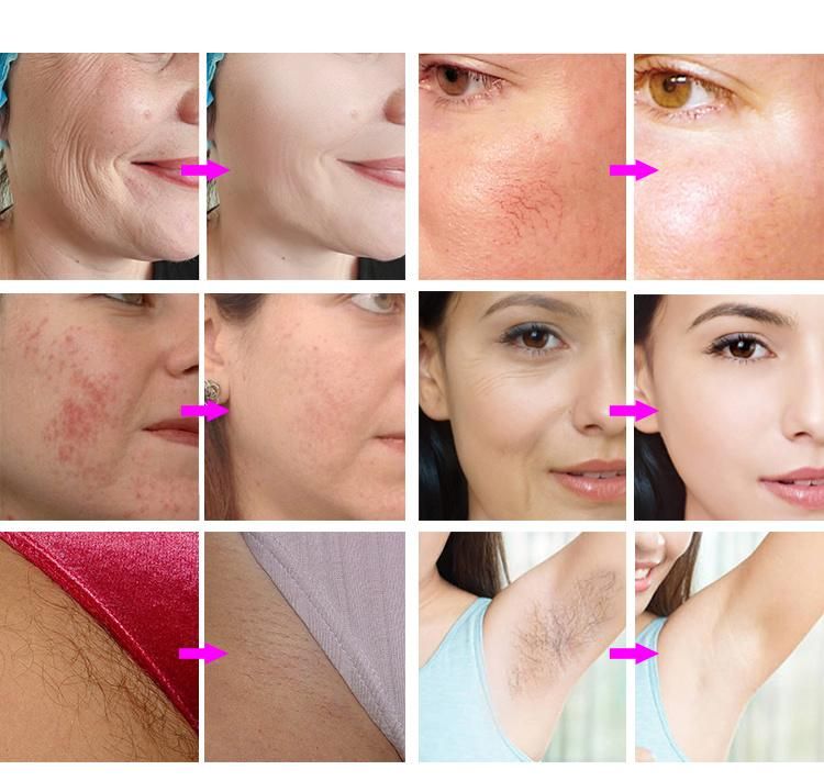 Huge Discount 6 Working Modes 3 Wavelengths Skin Rejuvenation Acne Freckle Redness Removal and Permanent Hair Removal Beauty Salon Equipment