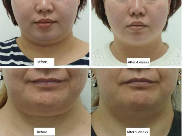 Jo. Sincoheren Diamond Coolplas Cryolipolysis Body Slimming and Weight Loss Machine for Beauty Salon