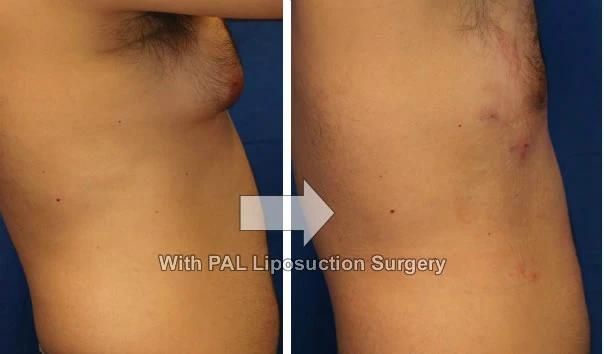 Tumescence Liposuction with Cannula
