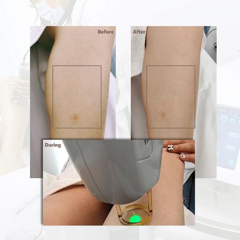 Alexandrite Laser Cooling Gentle Laser Max PRO Dual Wavelength Alexandrite Laser 755nm 1064nm YAG Laser Hair Removal Machine