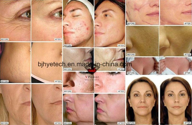 Permanent Make up Derma Pen Skin Wrinkle Removal Electric Dermaroller System