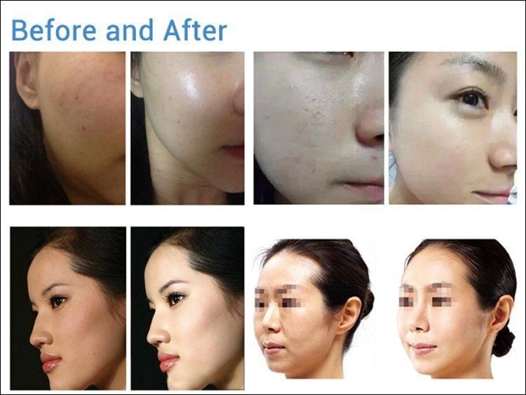 Hydra Wrinkle Removal Therapy Hot New Product in 2022 ADSS Grupo