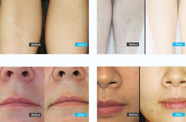 IPL Hair Removal Shr ND. YAG Laser Tattoo Removal Pigmentation Therapy Skin Rejuvenation Beauty Equipment