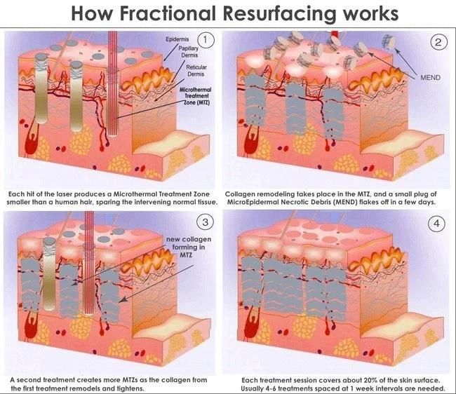 510K FDA CO2 Fractional Laser Skin Resurfacing Vaginal Tightening Machine