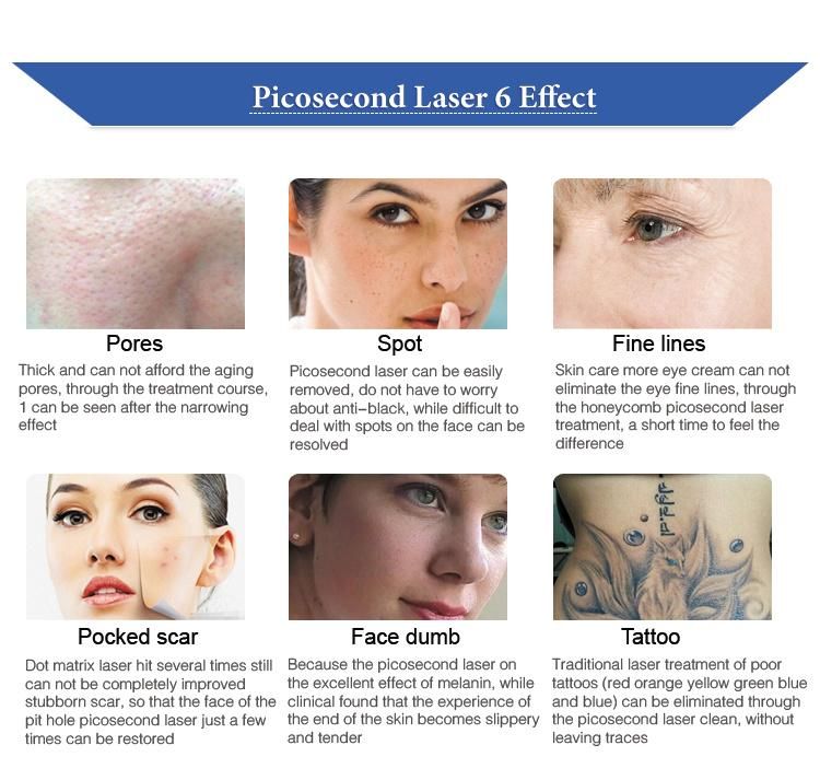 CE Approval Picosecond Laser Professional Freckles Removal Machine