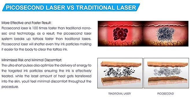 Picosecond Pigmentation Removal Laser Q-Switched Laser Machine ND YAG Tattoo Removal Laser