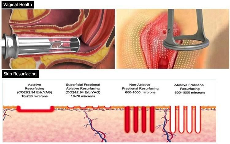 Medical Laser CO2 Fractional Laser Machine for Vagina Tightening and Strech Mark Removal