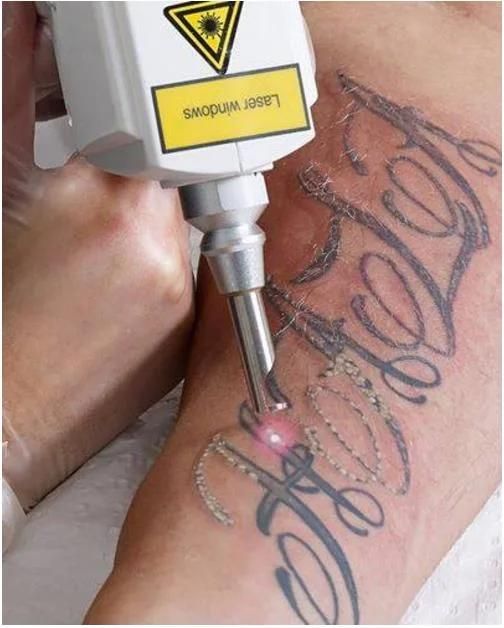 ND: YAG Laser Tattoo Removal Machine Carbon Peeling Machine Lowest