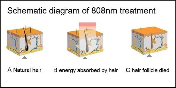 808nm Laser Diode Price/Alexandrite Diode Laser Hair Removal/808nm Diode Laser Hair Removal Machine