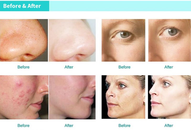 Vertical Oxygen Revive Hydra Facial Reduce Pigmentation Remove Acne and Freckles Beauty Equipment