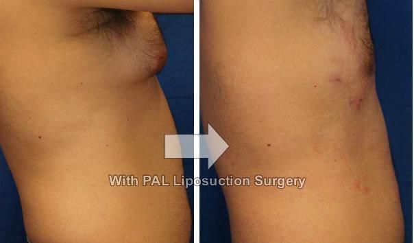 Water Jet Technology Surgical Liposuction