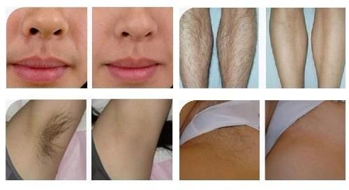 Medical Ce FDA Diode Laser 808nmhair Removal for Beauty Machine