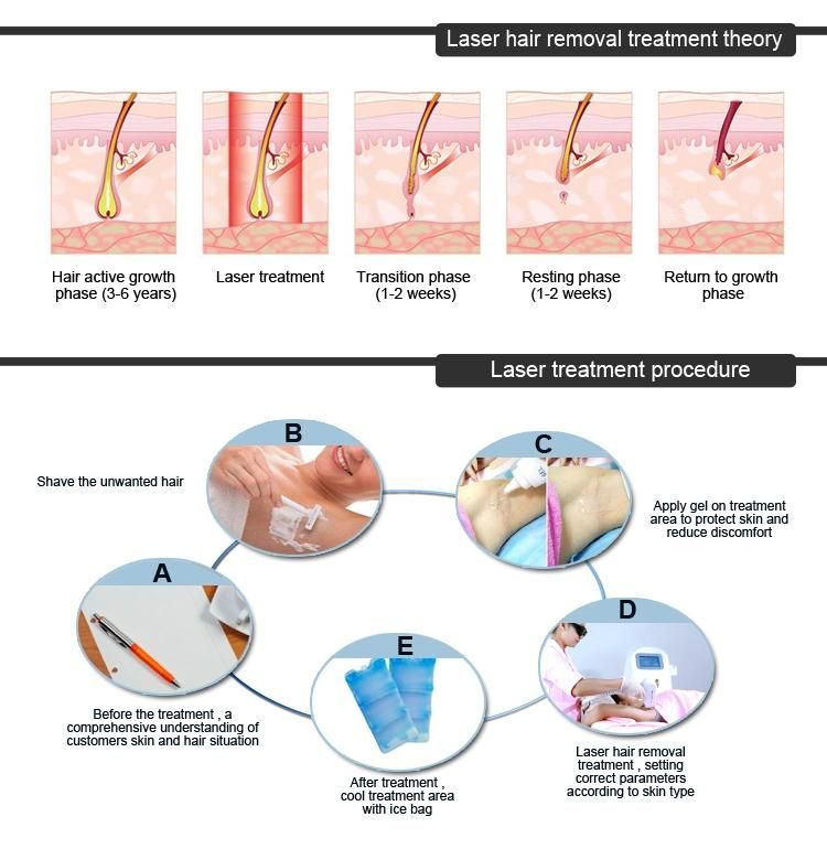 Salon Popular High Power 808nm Diode Laser Permanent Hair Reduction