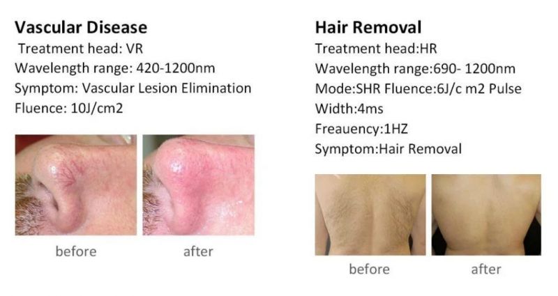 FDA Approved Hair Removal and Skin Removal IPL Machine