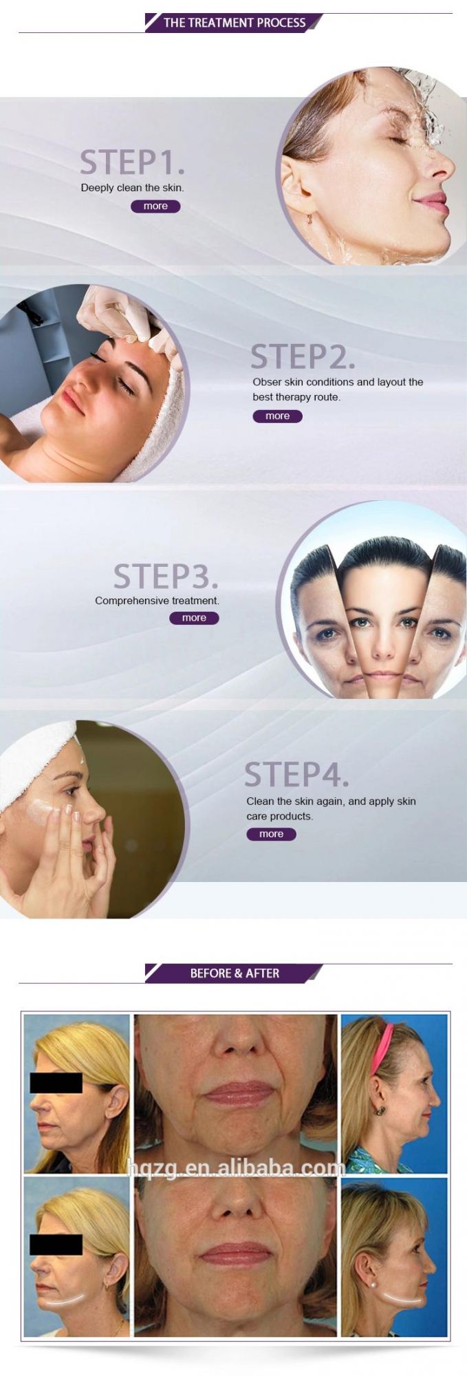 Beauty Face Lifting Wrinkle Removal Beauty Machine Popular in Beauty Salon