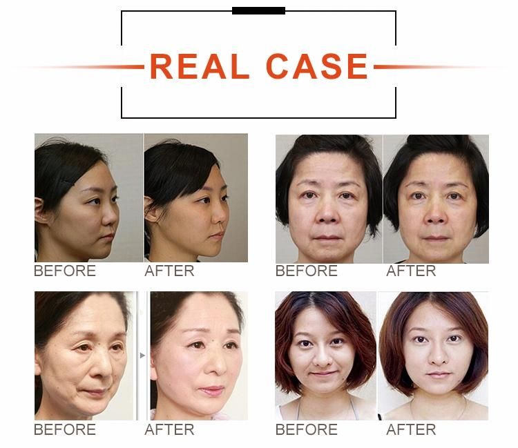 Ce Appoval Hifu Device for Face Lift /Wrinkle Removal/Skin Tightening