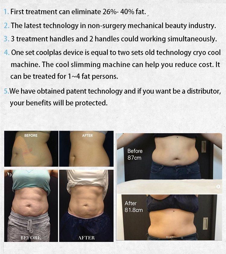 New Product Ideas 2019 Vacuum Cupping Lose Weight Cellulite Removal Venus Freeze Cavitation Fat Freezing Body Slimming Machine with Ce