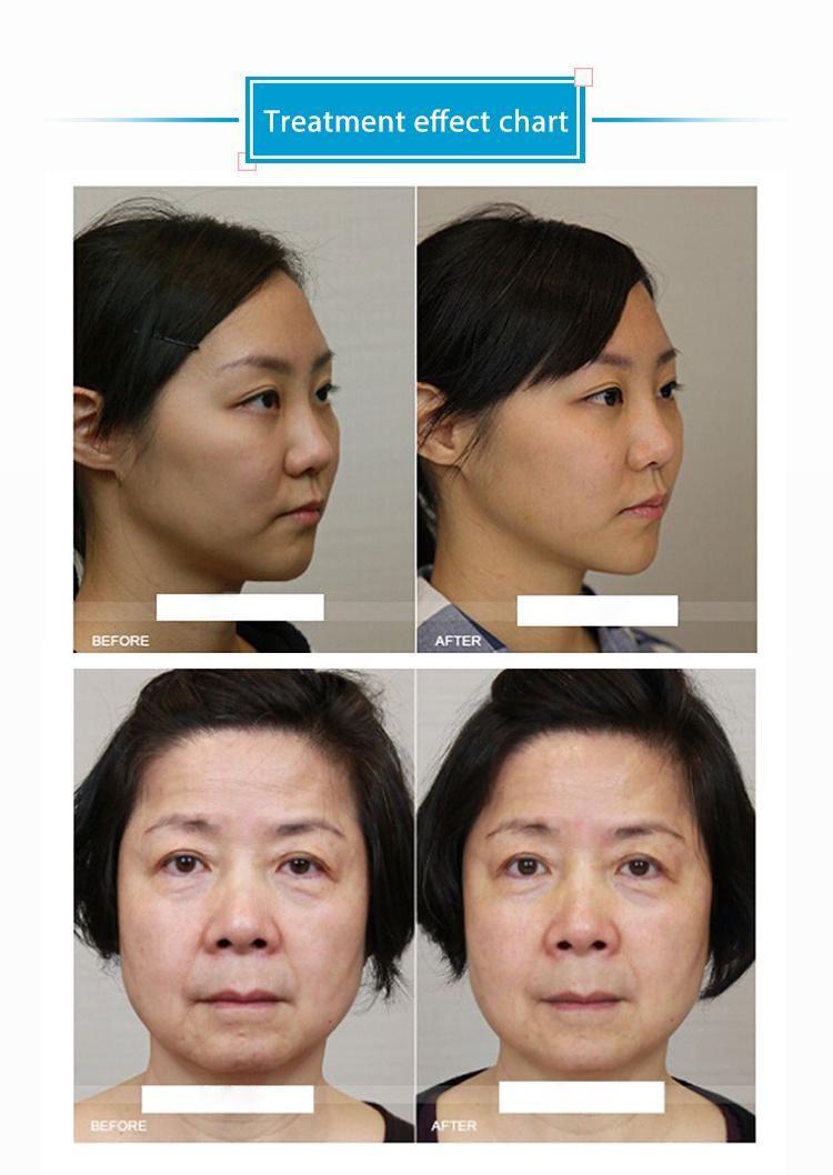 Salon Used 360 Hifu Face Equipment for Face Lifting