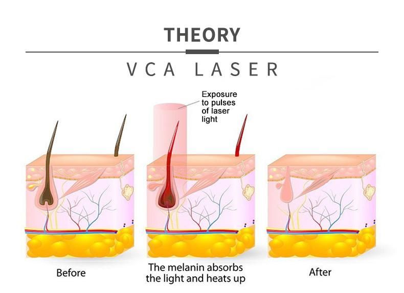 Powerful Germany Tec 808nm Diode Laser Hair Removal