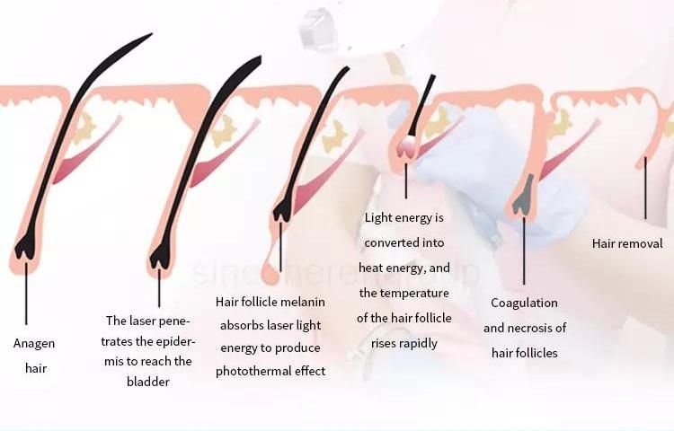 High Power Large Spot Multiple Wavelengths Diode Laser Hair Removal Machine