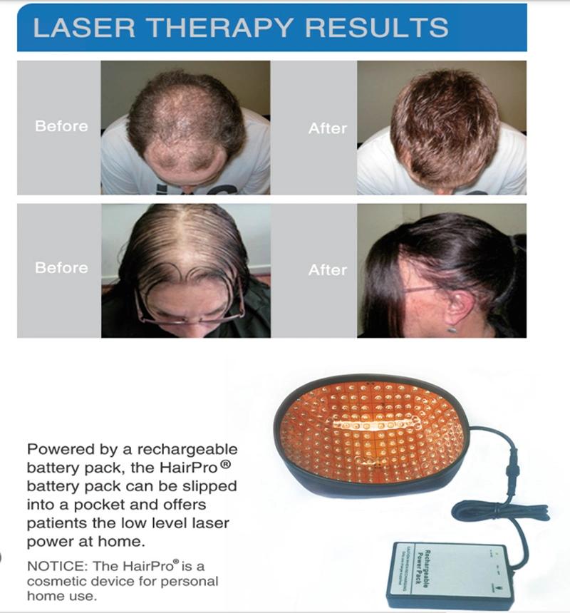 Laser Hair Helmet 272 Laser Diodes Make Hair Growth Cap