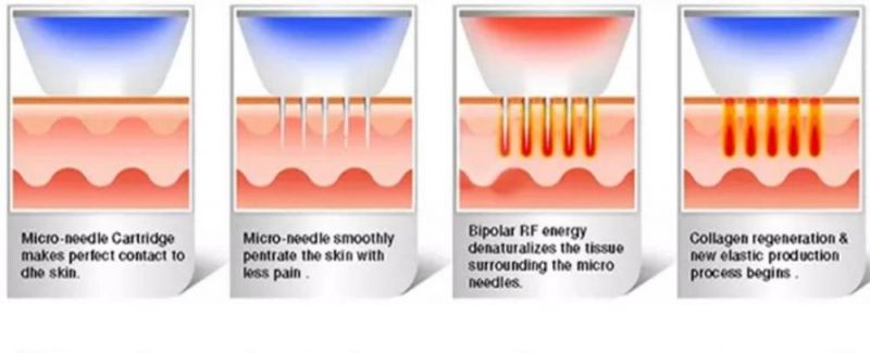 RF Gold Microneedles with Non-Insulated Needle Tip and Insulated Needle Body