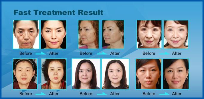 RF Microneedle Thermal Facial Lift Beauty Equipment