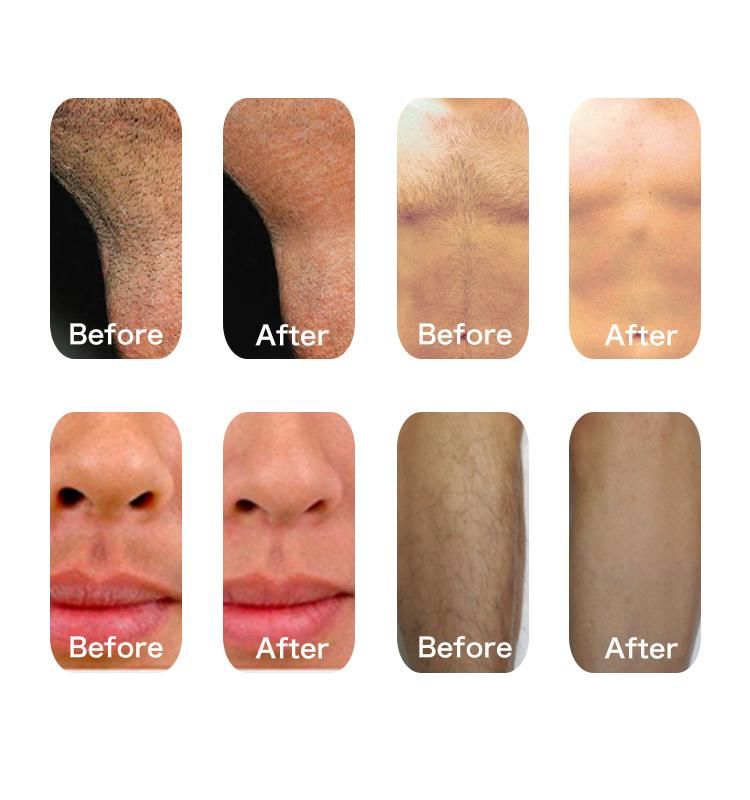 3 Wave Diode / Triple Wavelength Hair Removal / Diode Laser Hair Removal 755 808 1064