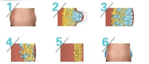 Vacuum Technology & Cooling System Reduce Abdominal Fat