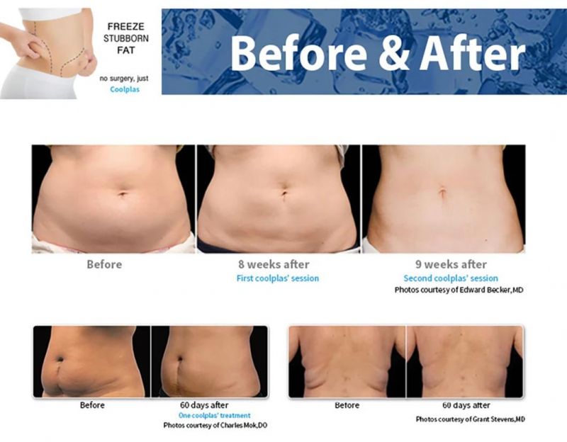 Jo. Fat Lipolysis Cellulite Reduction Double Chin Fat Reduction Coolplas Stubborn Fat Remove Non Invasive No Pain No Surgery No Downtime Machine