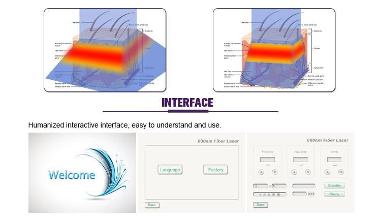 Fiber Coupled Diode Laser Hair Removal Machine 808nm Painless Epilator for Sale