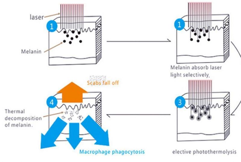 V-Acne Treatment Pigment Removal Pigment Removal YAG Laser