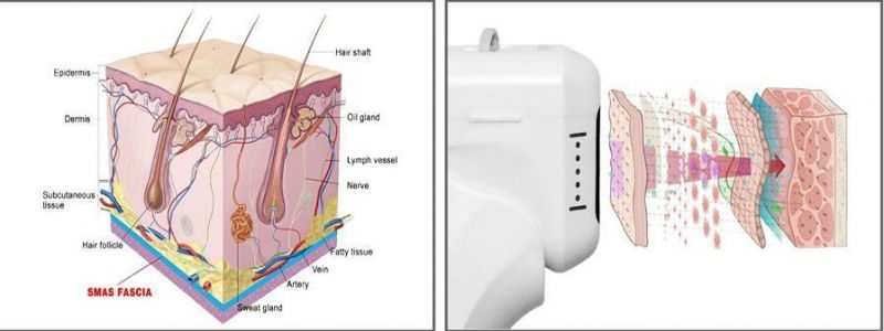 V-Skin Tightening Wrinkle Remover Anti-Puffiness Anti-Puffiness Anti-Aging with Machine