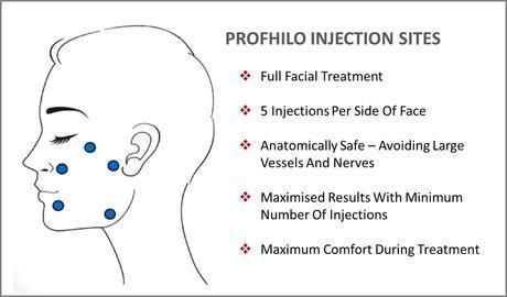 Top Sale CE Marked Injectable Hyaluronic Aicd Profhilo H+L Face Lifting Winkle Removal Profhilo Filler Rejuran Healer More Hyaluronic Acid for Skin Rejuvenation