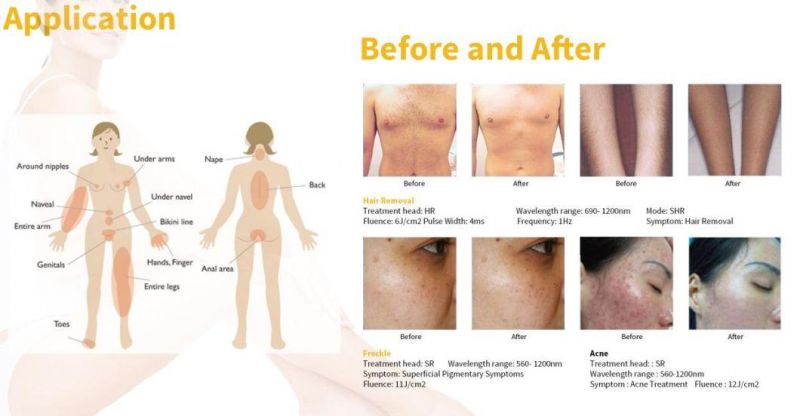 Medical CE Approved Opt IPL Hair Removal Used in Clinic Machine