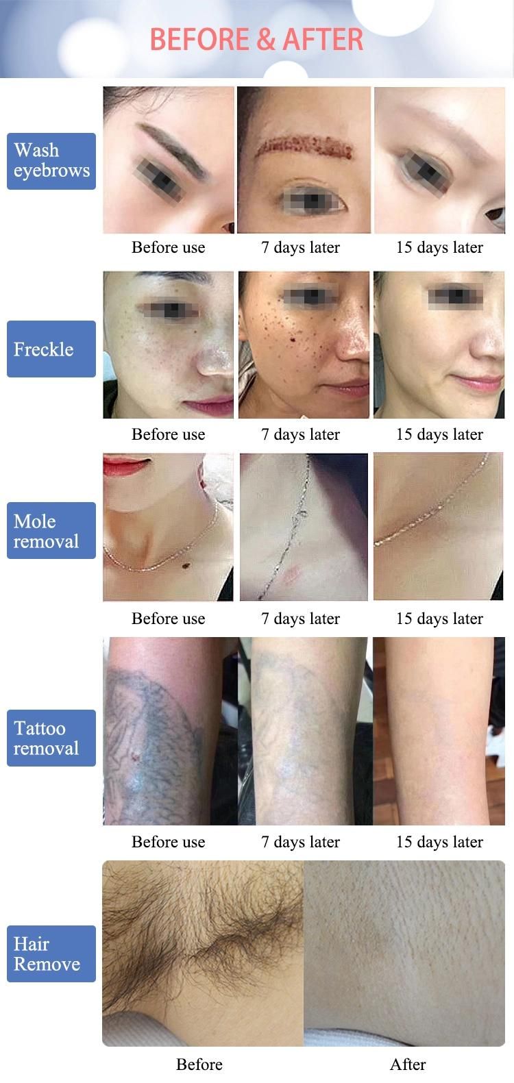 Picolaser Dark Spot Removing Tattoo Acne Removal Q Switched ND YAG Laser Picosecond Laser