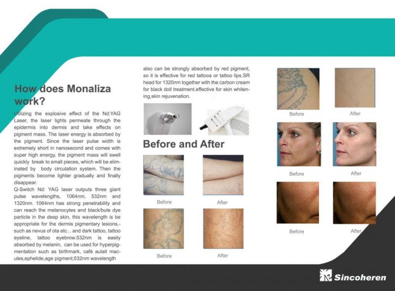 Consultant Be. Portable Tattoo Removal Pigmentation Removal Q Switched ND YAG Laser 532nm 1064nm 1320nm Monaliza