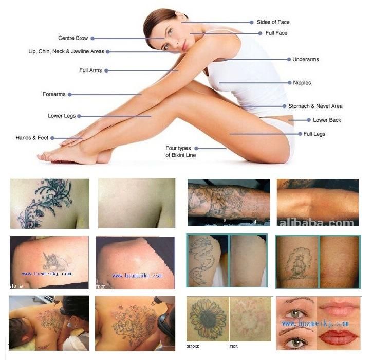 Q Switch Laser for Tattoo Removal (with Double Rods)
