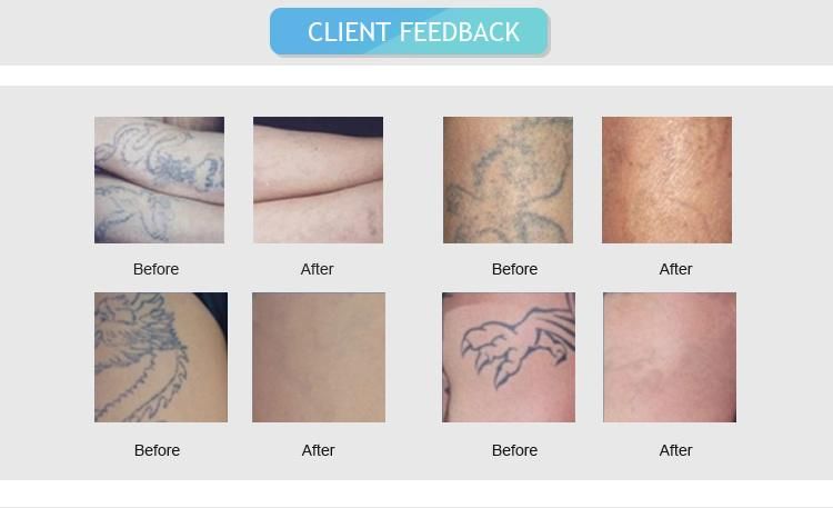 ND YAG Laser Tattoo Removal for 1064nm and 532nm FDA Ce