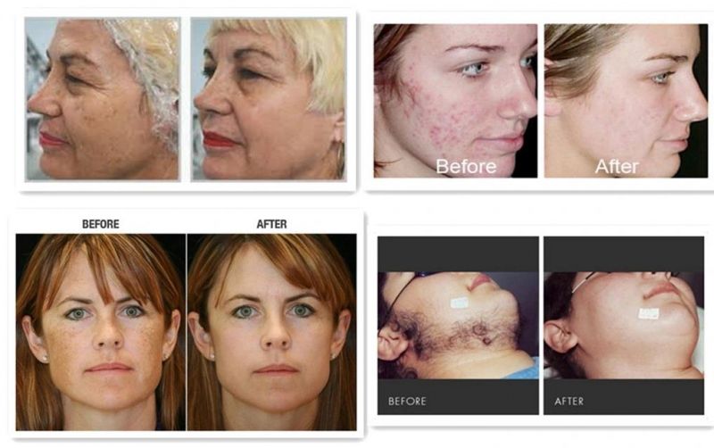 IPL Super Hair Removal Beauty Salon Machine