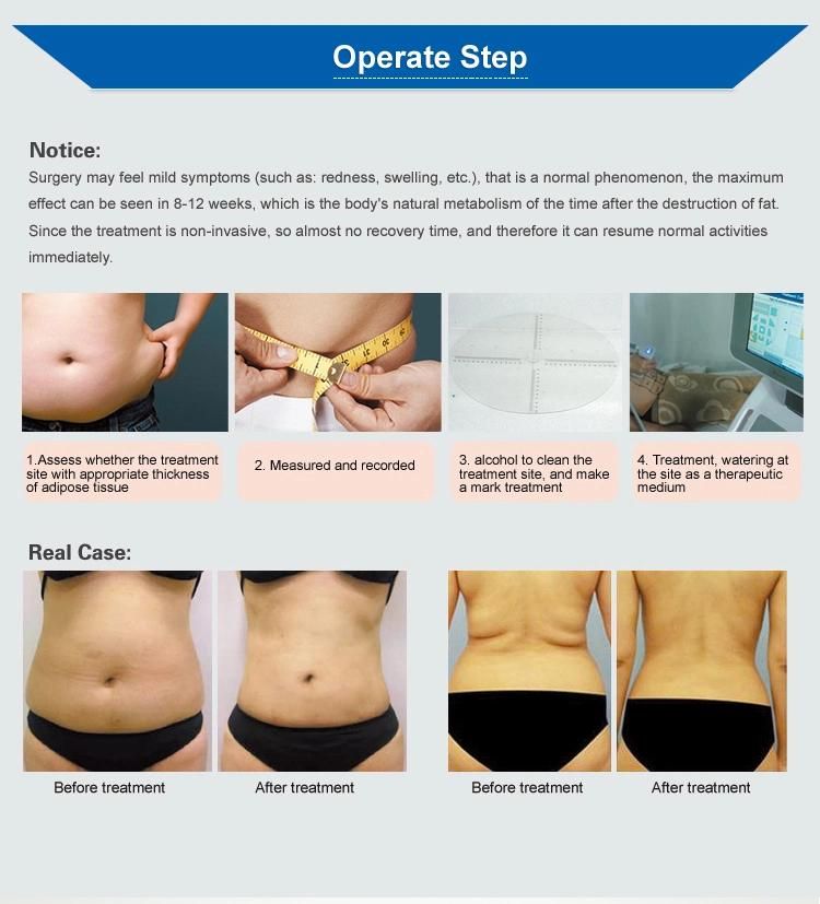 Liposonix Slimming Machine for Body Fast Weight Loss