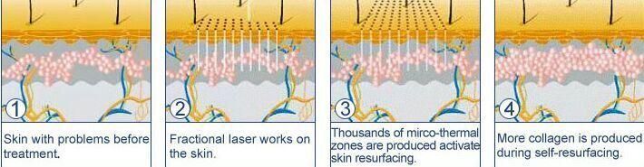 Glass Tube Fractional CO2 Laser Skin Resurface Medical Equipment