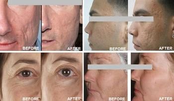 Erbium Laser 2940 Fractional Laser with Good Treatment Result for Wrinkle and Fine Lines Removal