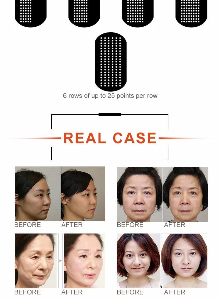 Ultrasonic Beautiful Instrument Hifu Focused Face Lifting Machine