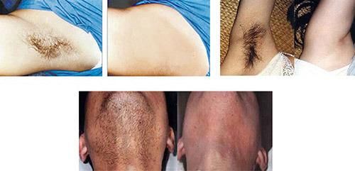 Best Quality Hair Removal 808/810nm Diode Laser Supplier