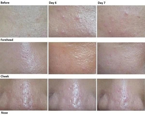 Fractional Laser CO2 Laser Skin Care Vagina Tightener Resurfacing